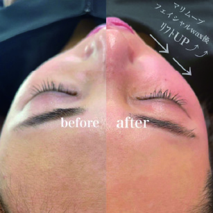 before after